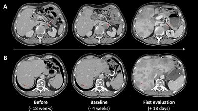 Hyperprogressive Disease After Combined Anti-PD-L1 and Anti-CTLA-4 Immunotherapy for MSI-H/dMMR Gastric Cancer: A Case Report